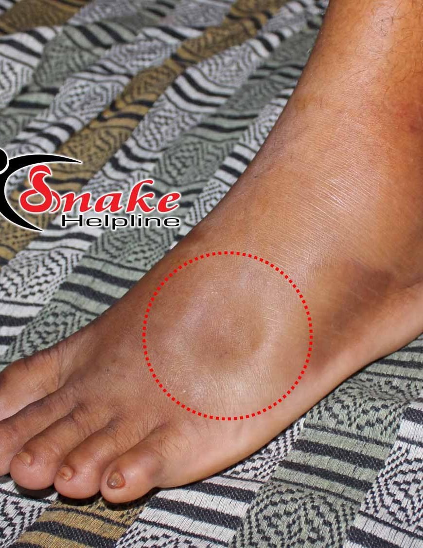 Pitting edema